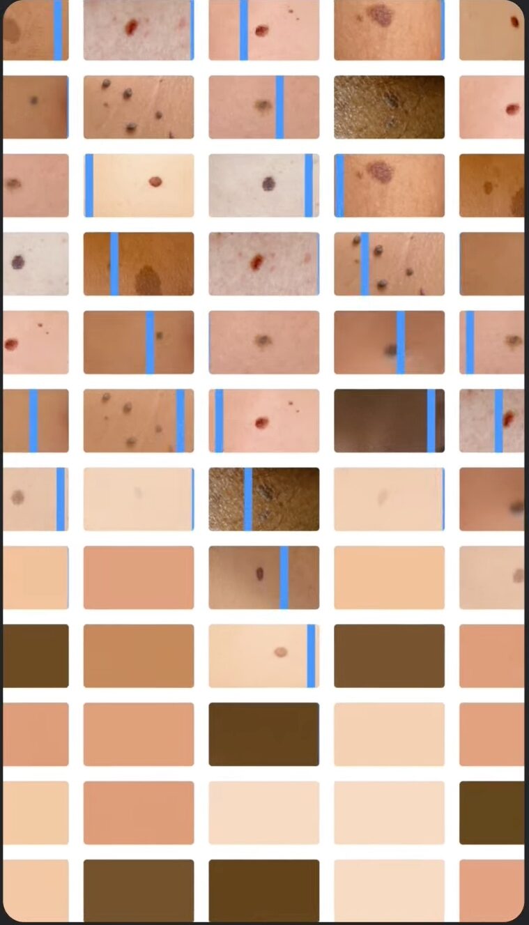 Google DermAssist 0 screen